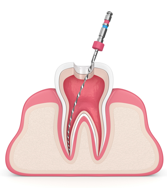 Play Y4 S1 Endodontic quiz study these multiple choice test questions and answers